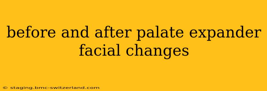 before and after palate expander facial changes