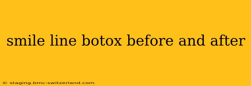 smile line botox before and after