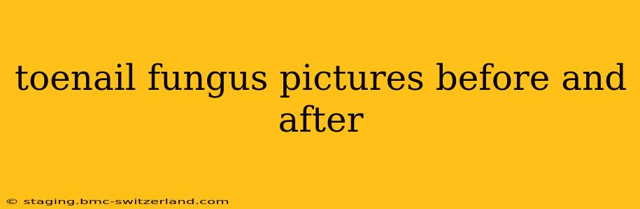 toenail fungus pictures before and after