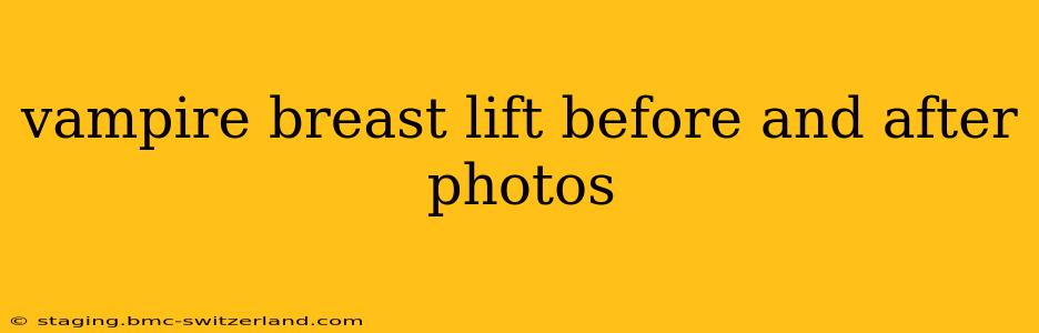 vampire breast lift before and after photos