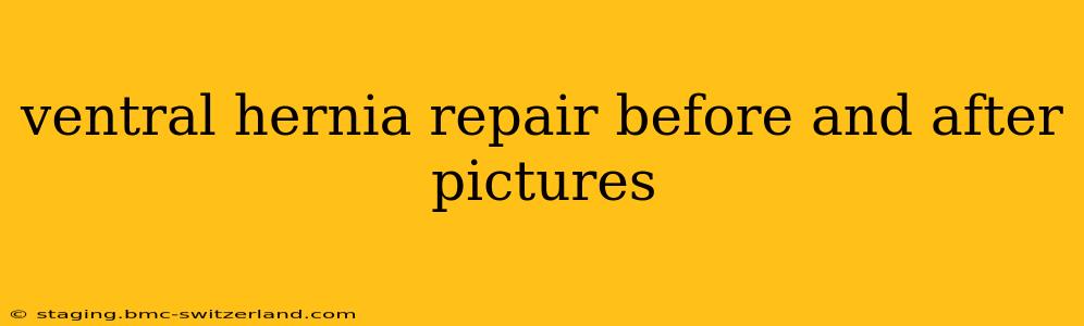 ventral hernia repair before and after pictures